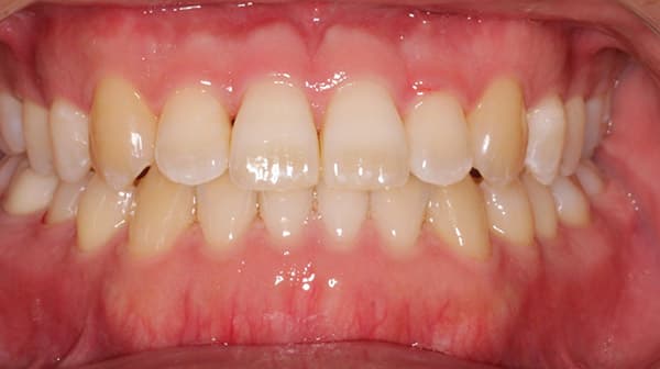 Case 2 after