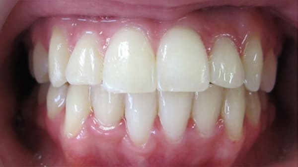 Case 4 after