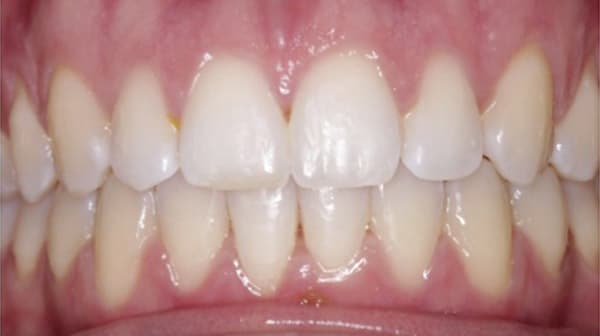 Case 5 after