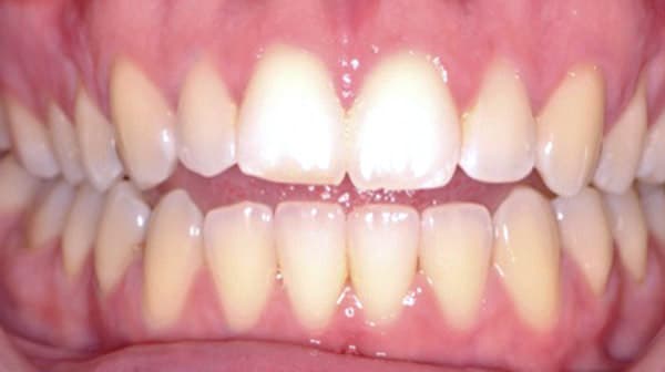 Case 5 before