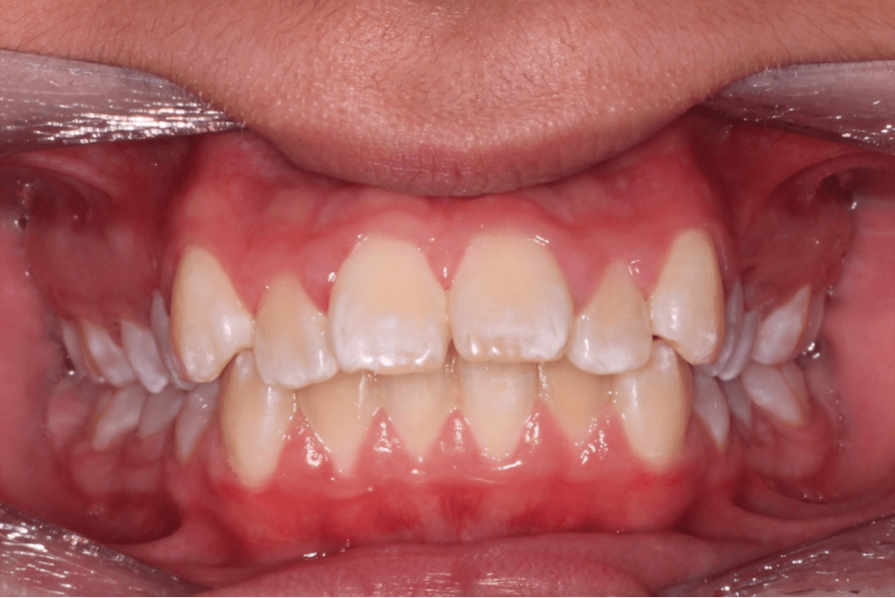 Case 6 before